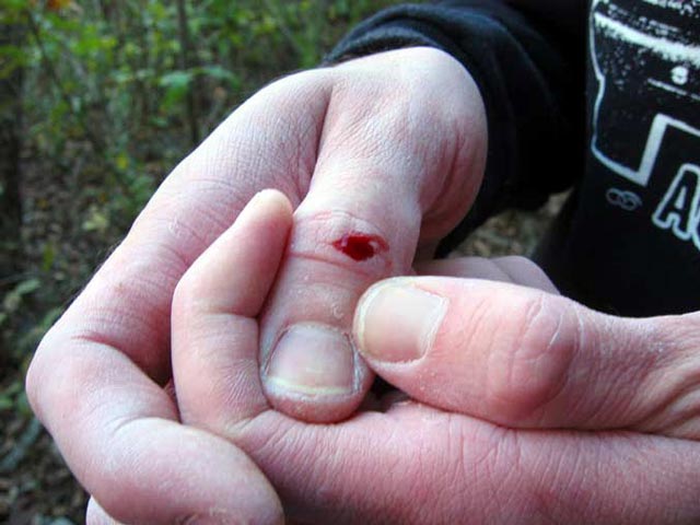 a bloody flapper: a tear in the skin of a climber's finger